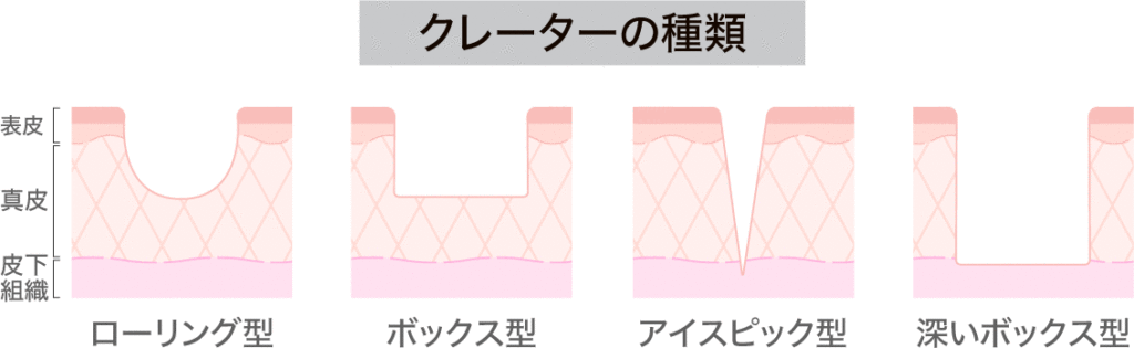 クレーターの種類